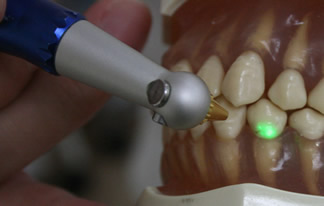 歯科用レーザー