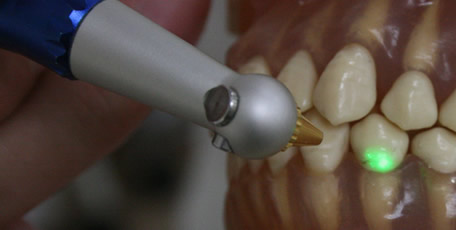 歯科用レーザー治療
